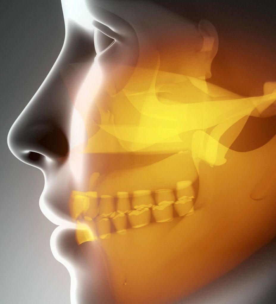 Stabilisation Splint TMJ | Doğudent Dental Clinic