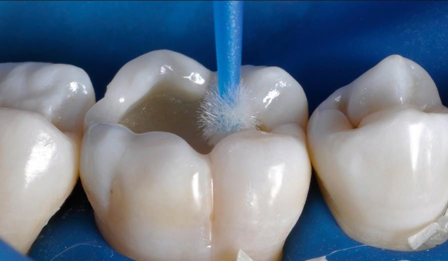 При этом удаляется лишь небольшое количество эмали, а структура зуба сохраняется.